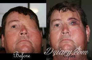 Na ratunek mogą przyjść tatuaże....