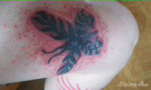 dermatolog stwierdził zakażenie, dostałam antybiotyk...