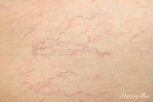 Dla zobrazowania, tzw. "pajączki".