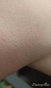 Tak wyglada ta wysypka z...