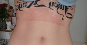 Cześć, hejka. We wtorek wykonałam... Reakcja alergiczna na dermalize?