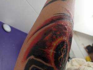 Utrzymująca się opuchlizna