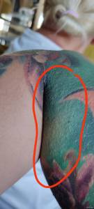 Wysypka po ekspozycji na słońce 