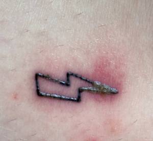 Sączenie się ropy na kilku dniowym tatuażu