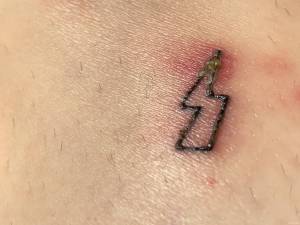 Sączenie się ropy na kilku dniowym tatuażu