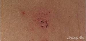 Czy jest to zakażenie?