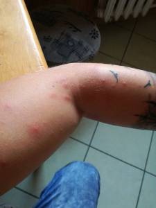 Dziwna wysypka trądzik po zrobieniu tatuazu