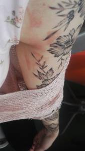 Czerwone plamy i wysypka