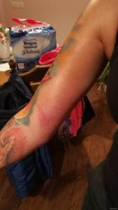 Opuchlizna i zaczerwienienie