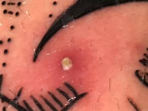 Krosta przy tatuażu