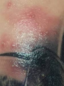 Białe krosty przy i na tatuażu 