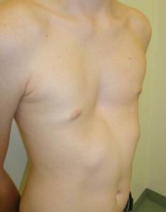 Tatuaż na klatce piersiowej (zatuszowanie deformacji klatki)