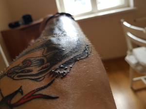 Swędząca wysypka na tatuażu