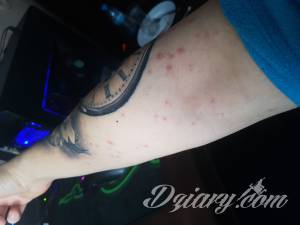 Krosty po zrobieniu tatuażu