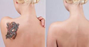 Usuwanie tatuażu laserem - współpraca dla studia tatuażu