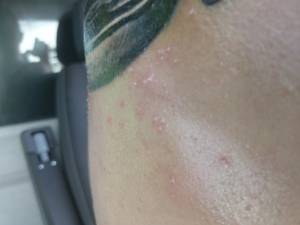 Dziwne krostki na świeżym tatuażu!  Pomocy! 