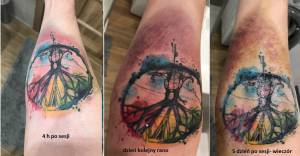 Ogromny siniak po tatuażu 