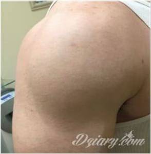 LASEROWE USUWANIE. PIELĘGNACJA