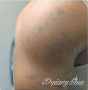 LASEROWE USUWANIE. PIELĘGNACJA