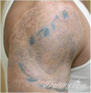 LASEROWE USUWANIE. PIELĘGNACJA