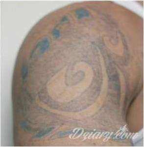 LASEROWE USUWANIE. PIELĘGNACJA