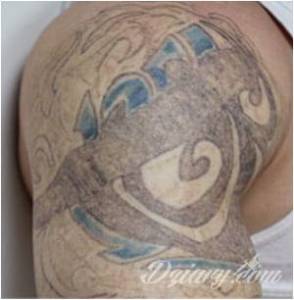 LASEROWE USUWANIE. PIELĘGNACJA