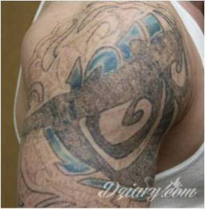 LASEROWE USUWANIE. PIELĘGNACJA