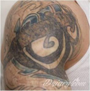 LASEROWE USUWANIE. PIELĘGNACJA