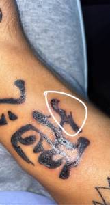 Źle gojący się tatuaż. 