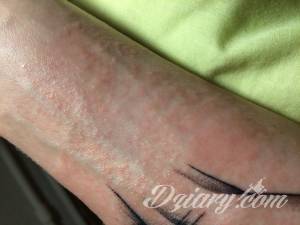 Uczulenie na nowym tatuażu