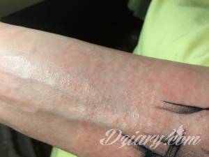 Uczulenie na nowym tatuażu