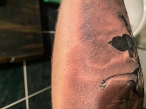 Witam, miałem robioną dziarkę 2... Alergia po tatuażu