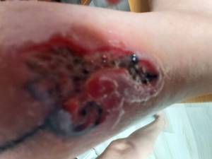 Oszpecenie przez tatuaz