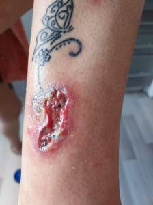 Oszpecenie przez tatuaz