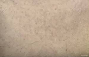 Tatuaż na chorej skórze