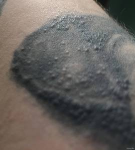 Czy jest to Alergia po bardzo długim czasie  - usunięcie tatuażu ? 