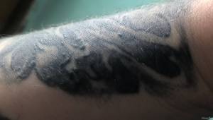 Czy jest to Alergia po bardzo długim czasie  - usunięcie tatuażu ? 