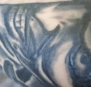 Wypukłe miejsca po strupach 