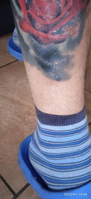 Jak myślicie zagoi się czy poprawka będzie???