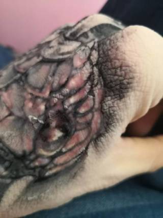 Po 5dniach od zrobienia tatuażu schodzi mi skóra, lecz wydaje mi się że konkretnie za mocno się to dzieje, dbam o niego jak o poprzedni który robiłem. 